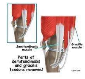 lesioni_caps_1
